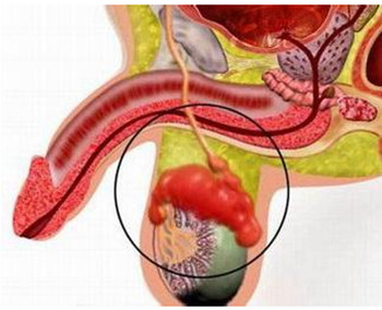 河池附睾炎的常见并发症