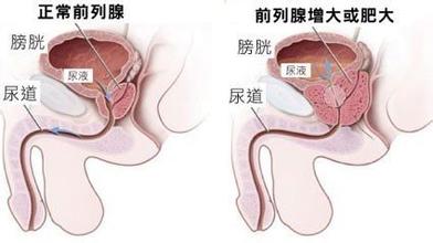 河池前列腺增生可以药物治疗吗