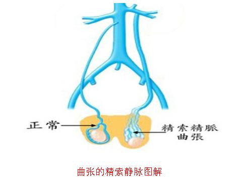 河池治疗精索静脉曲张曙光医院好