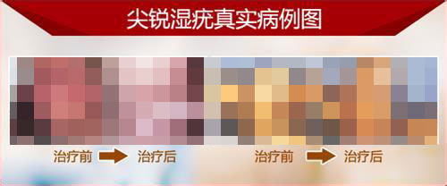 治疗尖锐湿疣需要多少钱