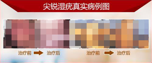 尖锐湿疣治疗费用多少