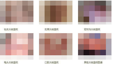 尖锐湿疣能治好吗