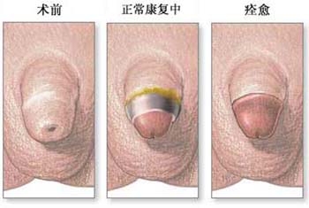 河池割包皮费用是多少?