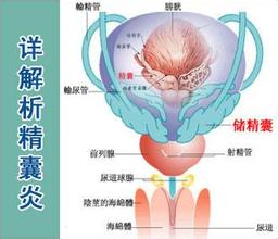 男性得了精囊炎该怎么办?