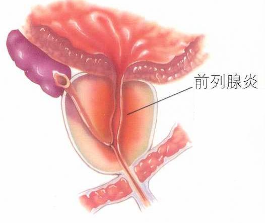 慢性前列腺炎的症状