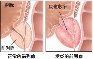 河池前列腺增生需要做哪些必要的检查