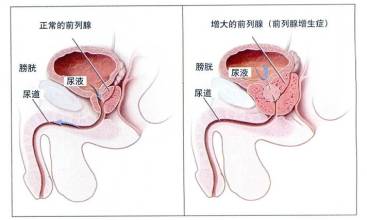 什么是前列腺炎增生