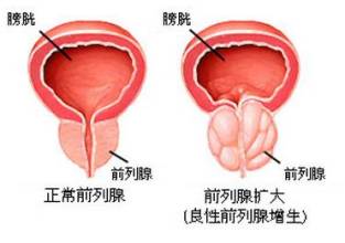 夜尿频繁是前列腺增生的症状