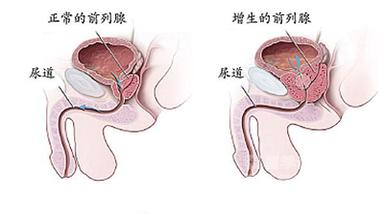 前列腺增生早期信号？