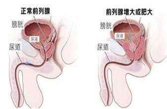 前列腺增生在开始的症状是怎样的?