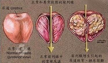 前列腺结石要怎么预防才好?