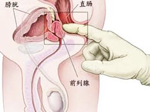 河池前列腺增生的症状有哪些