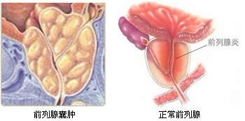 前列腺囊肿会不会危害到性功能？