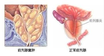 前列腺囊肿会造成的危害？