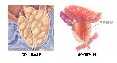 前列腺囊肿的类型？