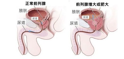 前列腺肥大