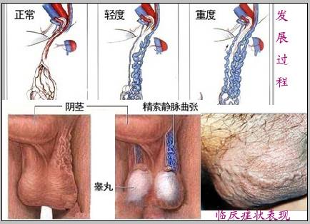 河池精索静脉曲张能治好吗